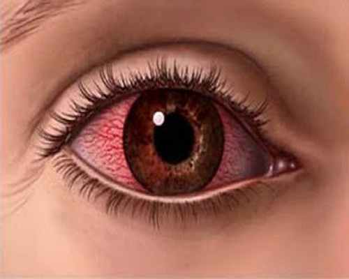 Triệu chứng, biểu hiện bệnh đau mắt đỏ